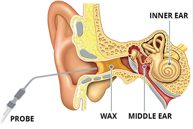 inner ear showing wax removal procedure